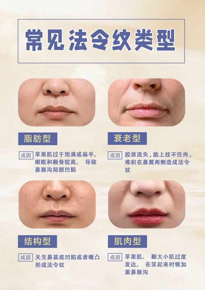 法令纹入口，探索面部美学与衰老的微妙平衡插图