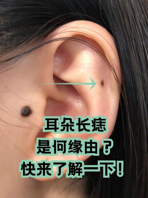 佛痣介绍，耳上长痣福气显。插图