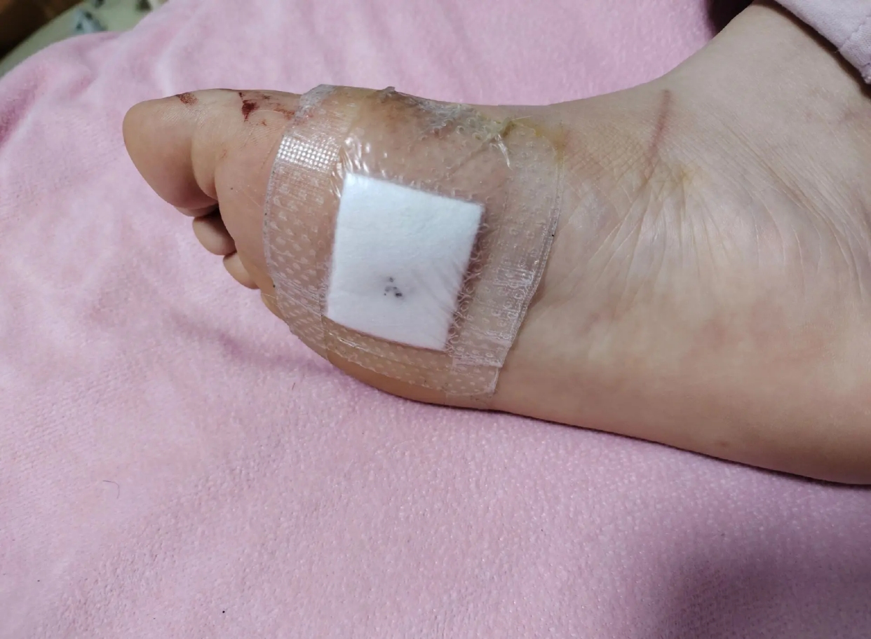 脚底有痣，何妨？如何正视与守护插图