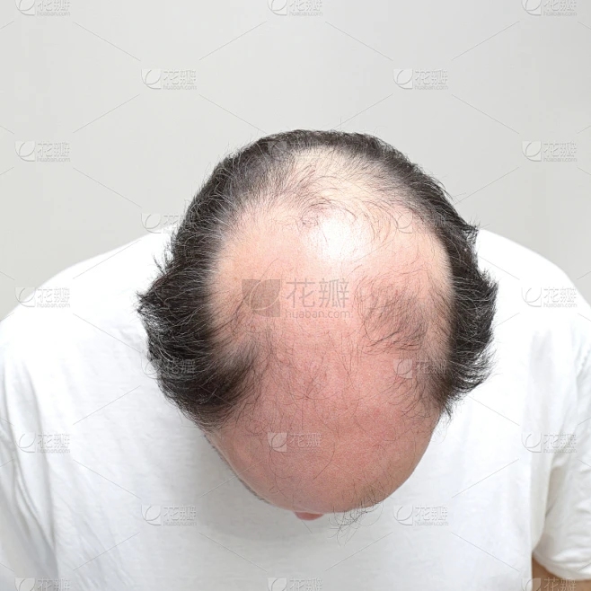 梦见秃头警示情绪波动插图 梦见秃头警示情绪波动插图