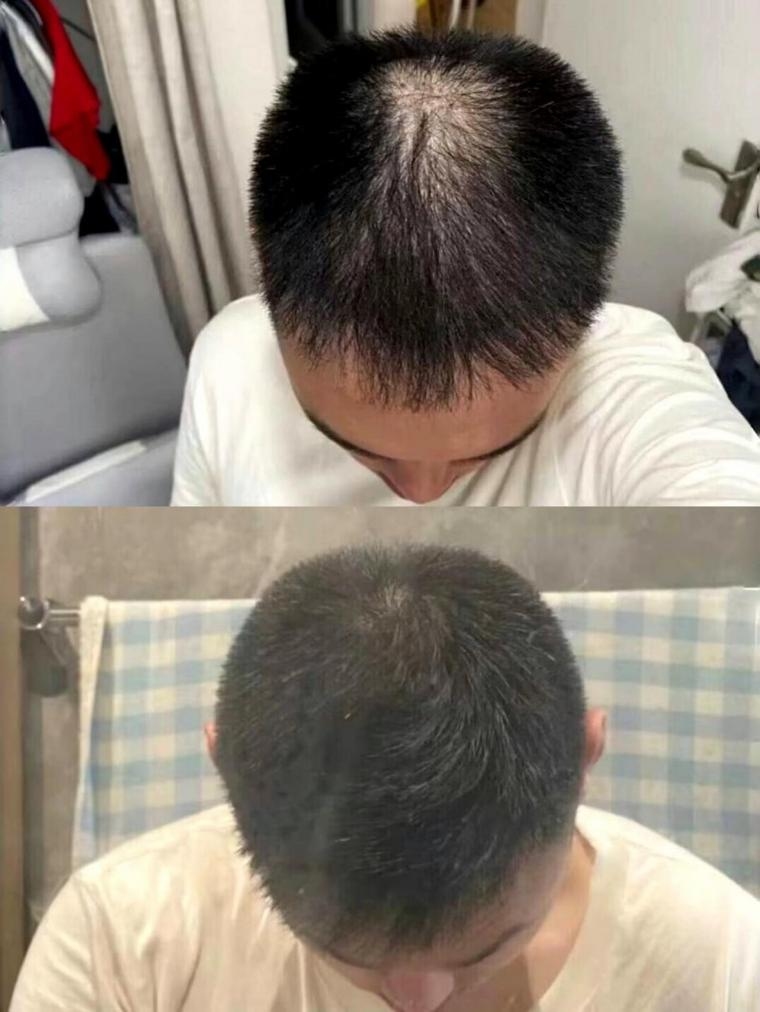 梦中的脱发，觉醒与非典型脱发的双重现象插图