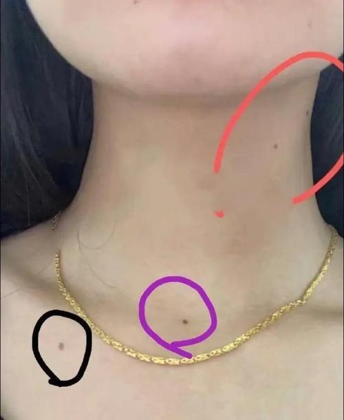 锁骨痣，守护生命的独特印记插图