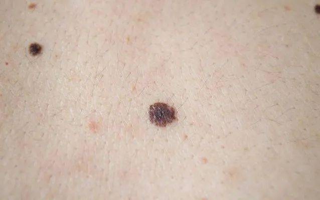 右脚底痣象征意义与癌变疑虑插图