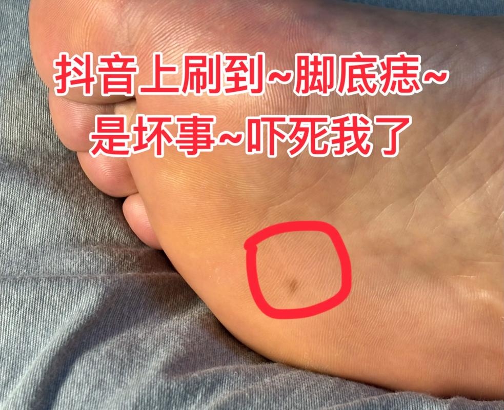 右脚脚底有痣需关注，位置影响易引发困扰插图