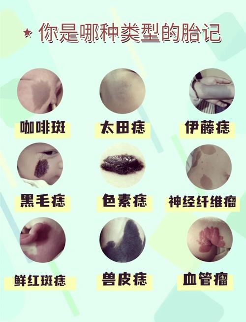 胎记位置解读及福气特征插图