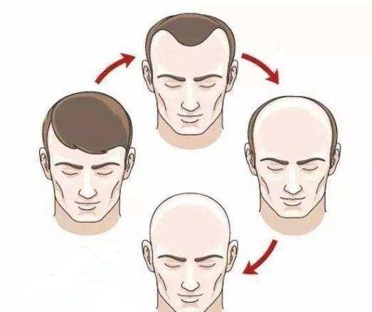 男人梦见自己秃顶，预示好运与成功？插图