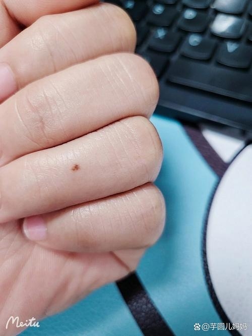 左手无名指长痣，生命的印记与成长的见证插图