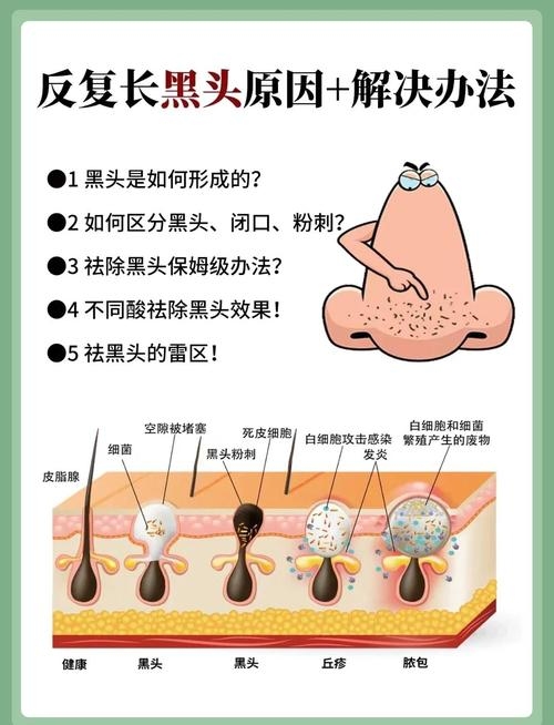 揭秘草莓鼻,成因与特征对比解析插图 揭秘草莓鼻,成因与特征对比解析插图