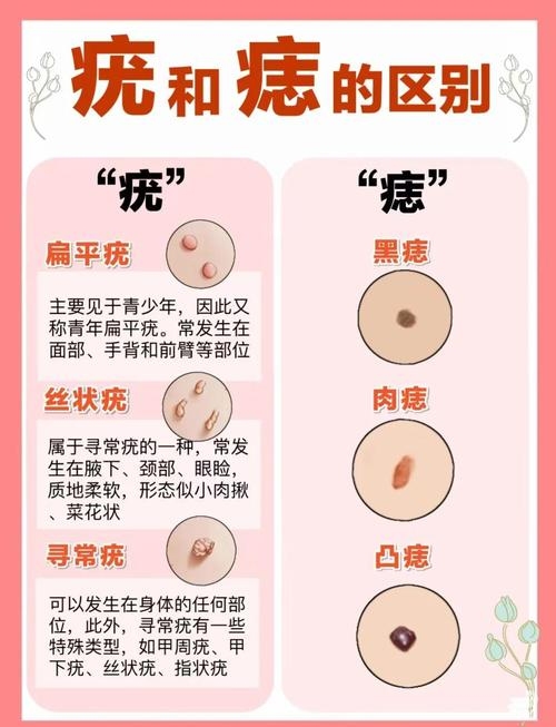 痦子的位置，科学视角下的认知与预防指南插图