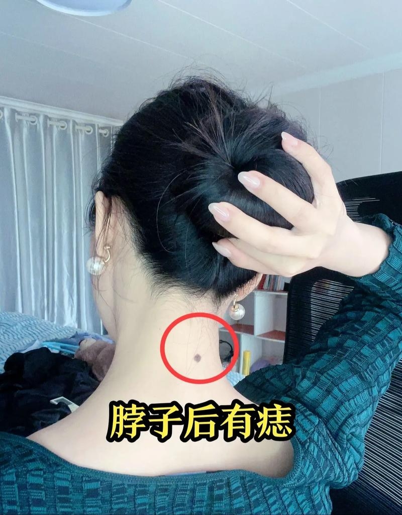 脖子后痣象征靠山，财富丰裕插图