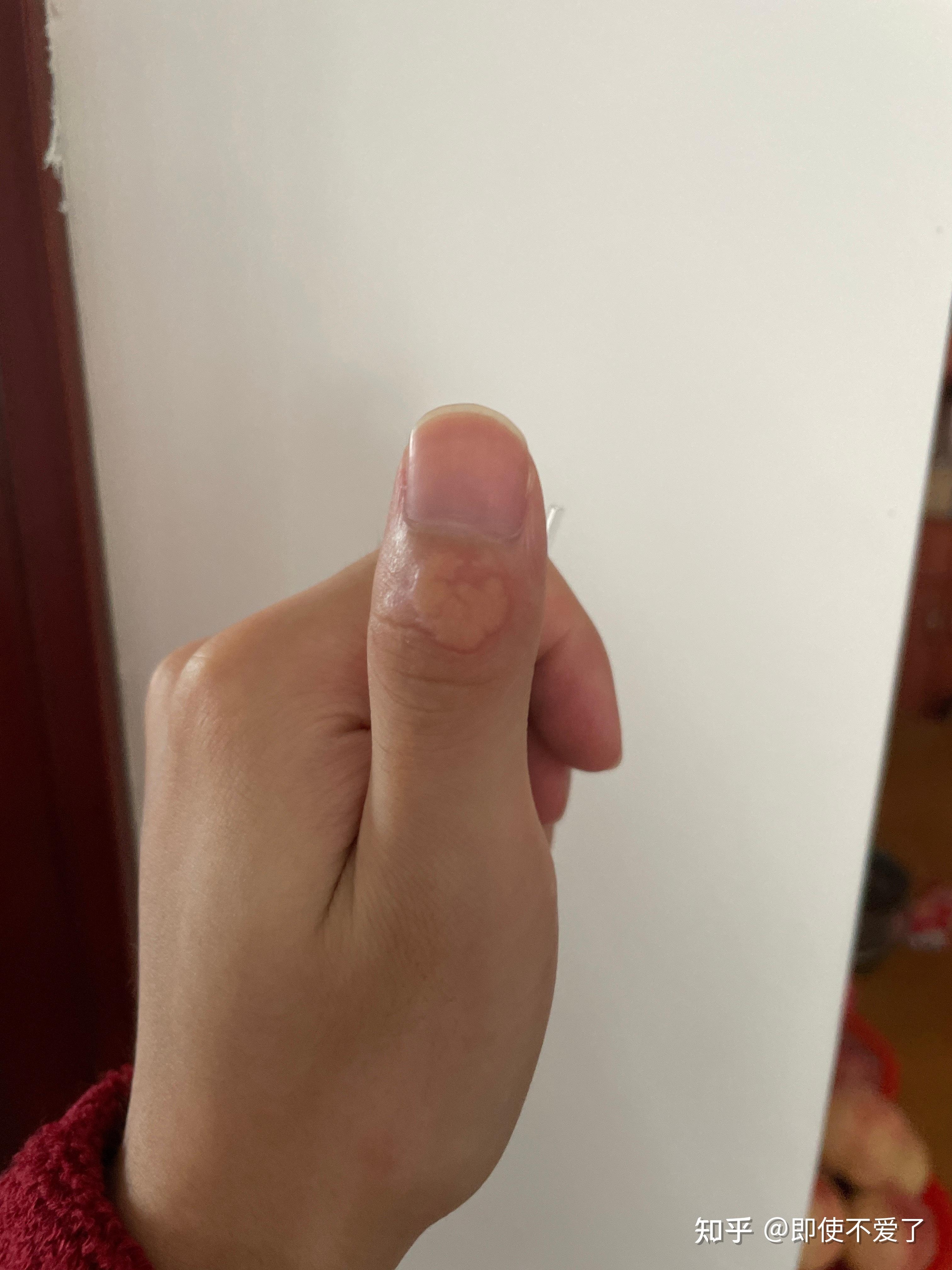 痦子位置多有科学解释，点除需谨慎插图