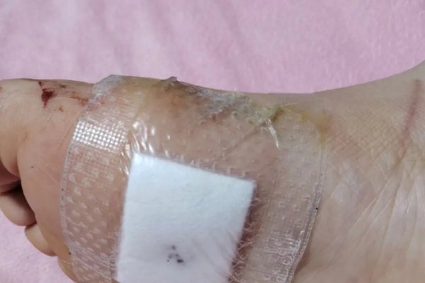 脚底有痣，何妨？如何正视与守护-方知甜