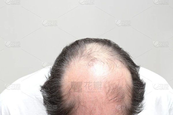 梦见秃头警示情绪波动-方知甜