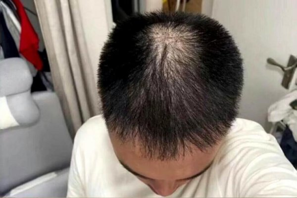 梦中的脱发，觉醒与非典型脱发的双重现象-方知甜