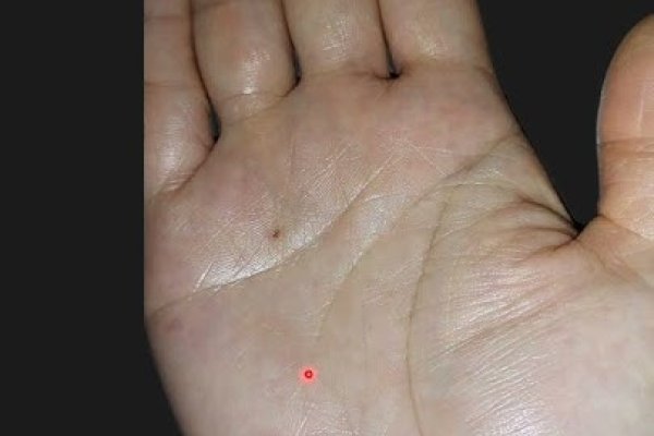 女人手背痣，传统寓意与现代解读的碰撞-方知甜