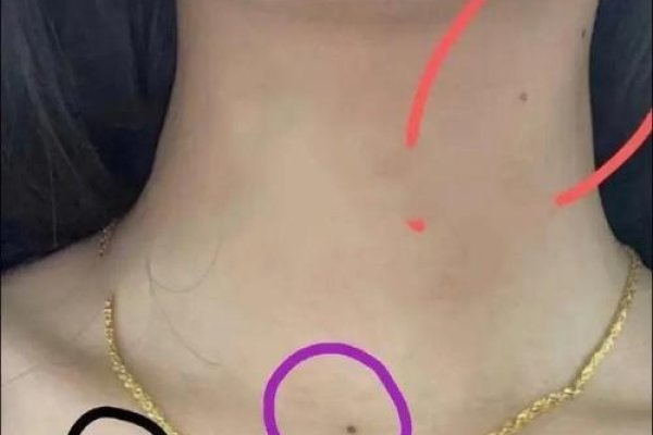 锁骨痣，守护生命的独特印记-方知甜