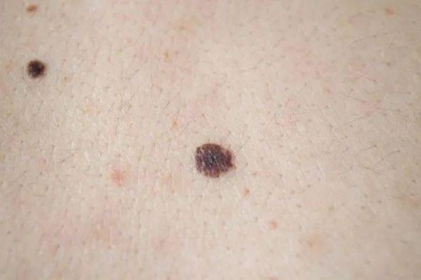 右脚底痣象征意义与癌变疑虑-方知甜