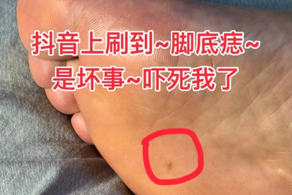 右脚脚底有痣需关注，位置影响易引发困扰-方知甜