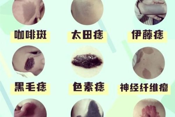 胎记位置解读及福气特征-方知甜