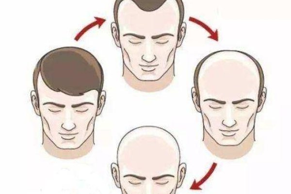 男人梦见自己秃顶，预示好运与成功？-方知甜