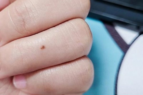 左手无名指长痣，生命的印记与成长的见证-方知甜
