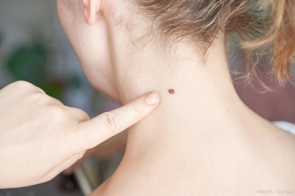 脖子后痣者多如掌上明珠-方知甜