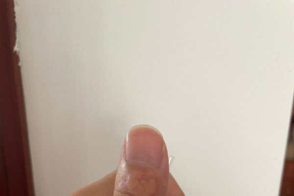 痦子位置多有科学解释，点除需谨慎-方知甜